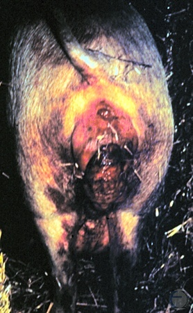 Necrotic Vaginal Prolapse.