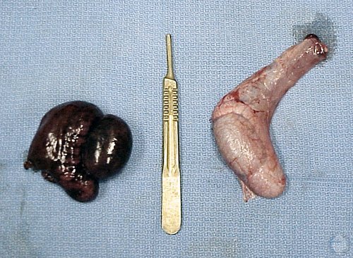 Cryptorchid and Testicular Torsion.