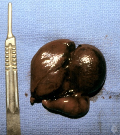 Cryptorchid and Testicular Torsion.