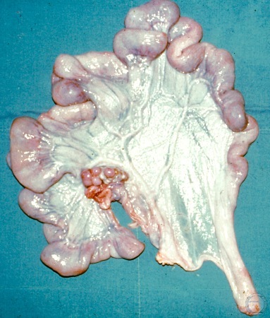 Uterus Unicornis.