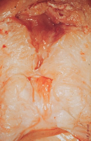 Cervical Adhesion.