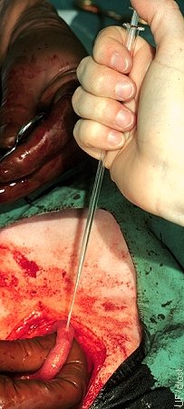 Colocación Quirúrgica del Embrión.