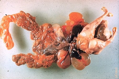 Schistosoma Reflexum de un Feto de 6 Meses de Edad.
