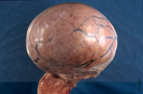Tumor Liso de Células de la Granulosa.