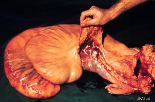 Ruptura de la Arteria Uterina.