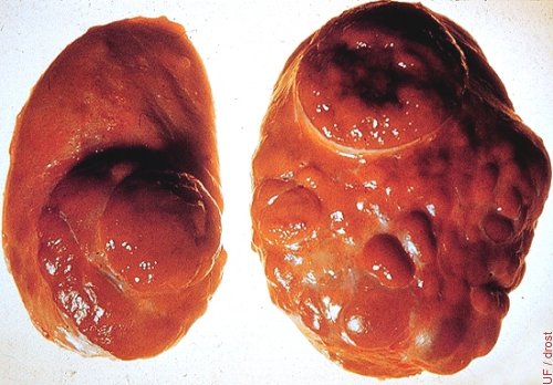Tumor de Células Intersticiales.