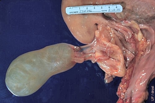 Close-up of Elongated Cystic Ovarian Bursa.