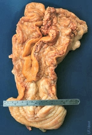 Uterine Tuberculosis.